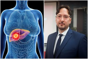 Vėžys vystosi, o skausmo nėra: chirurgas atsakė, kaip nepražiopsoti auglio kepenyse