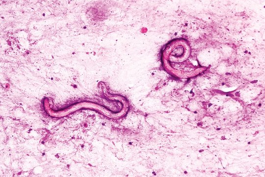 Klaikus atvejis: po transplantacijos – visame vyro kūne knibždantys kirminai