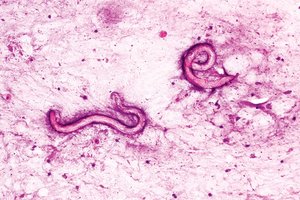 Klaikus atvejis: po transplantacijos – visame vyro kūne knibždantys kirminai