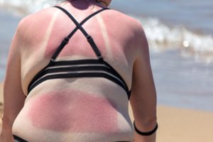 Per daug nusvilote saulėje? Vaistininkas pamokė, kaip padėti savo odai