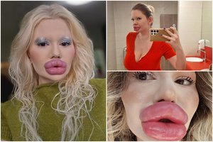 Svajonė turėti didžiausias lūpas moteriai skaudžiai atsirūgo: gydytojai atsisako net prisiliesti