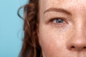 Pigmentinės dėmės: nesisaugojus saulės, pirmosios gali išryškėti dar šią vasarą