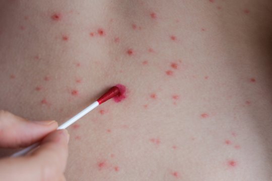 Vėjaraupiai suaugusiems – ne juokas: patarė, kaip išvengti galimų komplikacijų