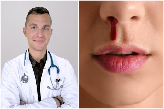 Kraujavimas iš nosies: kurio vitamino trūkumas gali jį sukelti?