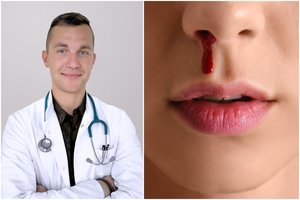 Kraujavimas iš nosies: kurio vitamino trūkumas gali jį sukelti?