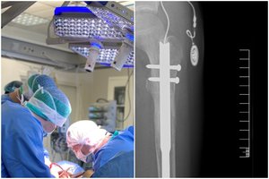 Vilniuje – medicinos stebuklas: gydytojai pailgino koją 6 centimetrais