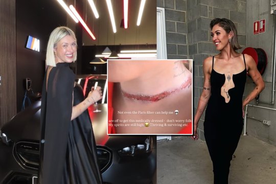 Populiarų aksesuarą vilkėjusiai nuomonės formuotojai vakaras vos nesibaigė tragedija: paviešino šiurpas žaizdas