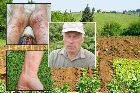 Daržas klebonui tapo tikru pragaru: rankas ir kojas nusėjo negyjančios pūslės