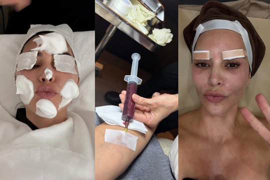 Kim Kardashian gerbėjus šokiravo keistos procedūros Pietų Korėjoje: injekcijos, lipni juosta ant antakių ir kaukės
