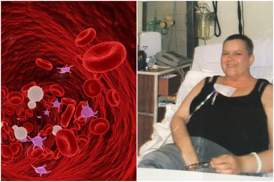 Keistas simptomas išdavė mirtiną kraujo ligą: pusamžė moteris manė, kad tai normalu