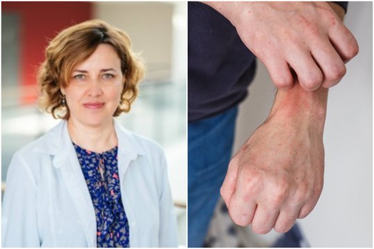 Gydytojos patarimas, kaip atpažinti dilgėlinę: tušinuko reikės, popieriaus – ne