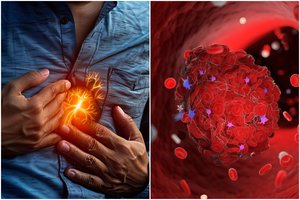 Kardiologai apstulbo, kas saugo nuo kraujo krešulių – veiksmingiau nei aspirinas