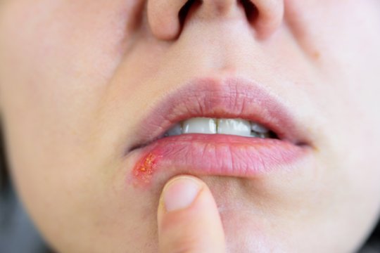 Pūslelinė – lyg nematomas palydovas: vaistininkė patarė, kaip išvengti jos protrūkių