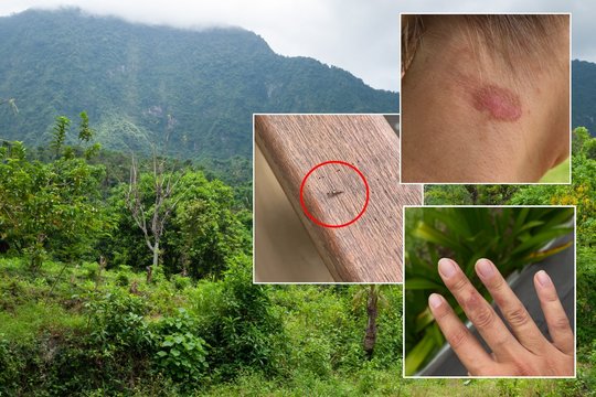 Lietuvė įspėja apie pavojų „turistų rojuje“: po nakties galite nubusti su skaudžiais nudegimais, lieka randai