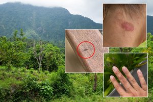 Lietuvė įspėja apie pavojų „turistų rojuje“: po nakties galite nubusti su skaudžiais nudegimais, lieka randai