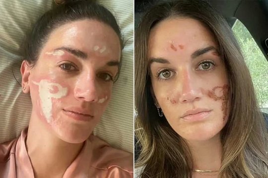 Po žvaigždžių kosmetologės procedūros moters veidas liko negrįžtamai subjaurotas: išleido milžiniškas sumas