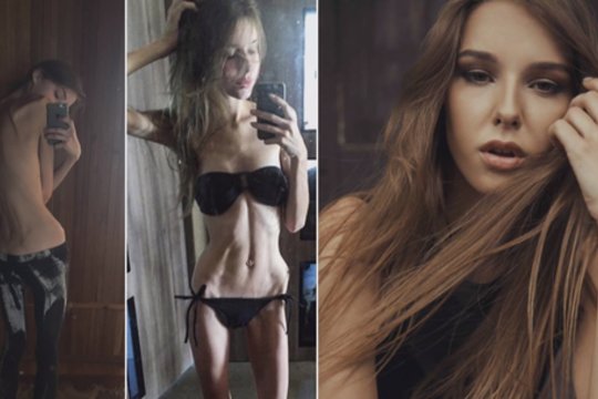 Anoreksija sirgusi manekenė Paula: svoris buvo toks mažas, kad netikau net apatinių reklamai