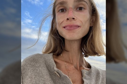 Tragiška baigtis: dėl „vaisių dietos“ užgeso jaunos studentės gyvybė