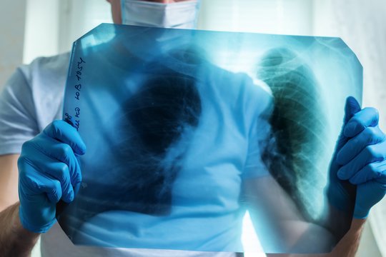 Saugus tyrimas padėtų laiku aptikti plaučių vėžį