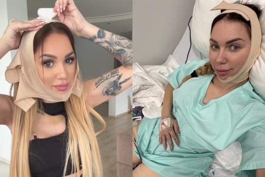 Justina Partikė parodė rezultatą po plastinės operacijos: pasakė, kas nepatinka