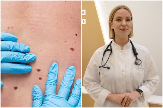 Nebereikia laukti eilėje pas dermatologą: melanomą diagnozuoti padeda dirbtinis intelektas
