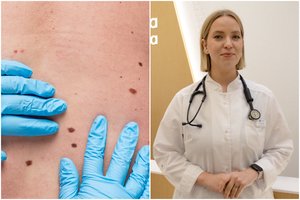 Nebereikia laukti eilėje pas dermatologą: melanomą diagnozuoti padeda dirbtinis intelektas