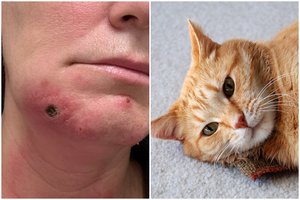Katinas užkrėtė šeimininkę mįslinga liga: ant veido atsivėrė baisios žaizdos