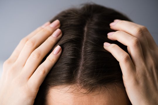 Ruduo – kepurių sezonas: ką daryti, kai galvos oda ima pleiskanoti?