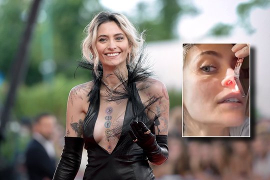 M. Jacksono dukra pirmą kartą parodė skaudžius narkotikų padarinius: vaizdas šokiruoja