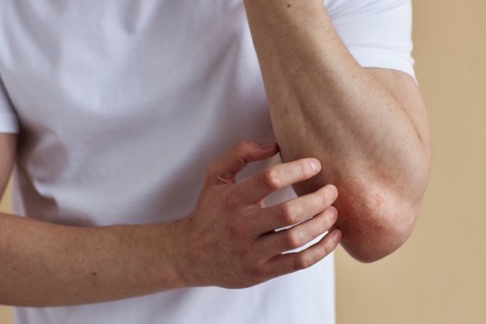 Pastebėjote psoriazės paūmėjimą? Štai, ką turite daryti