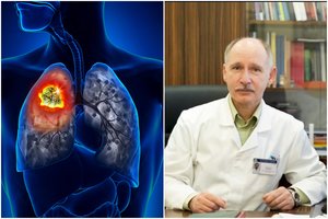 Profesorius įvardijo esminį vėžio sukėlėją: „Žmogus pats kviečiasi sau ligą“