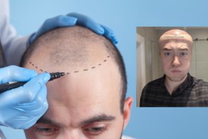 Po plaukų transplantacijos 26-erių britas tapo neatpažįstamu: kakta ištino dvigubai, akys vos atsimerkė