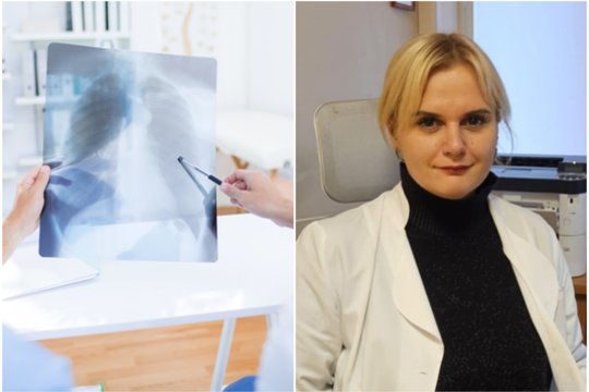 Plaučių liga, kurios diagnozę išgirdę pacientai nustemba: „Nieko negirdėjau apie tokią“