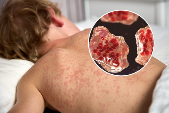 Pasaulyje plinta vienas iš užkrečiamiausių virusų: įspėjo, kam rizika susirgti didžiausia