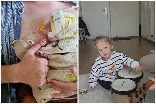 Medikai prognozavo, kad dvynukės gims negyvos: 30 operacijų ištvėrusi Kamilė negali verkti, bet kovoja už save