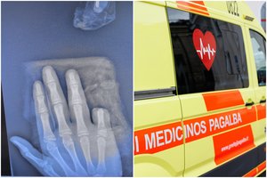 Alytuje petarda nutraukė 12-mečio berniuko pirštą