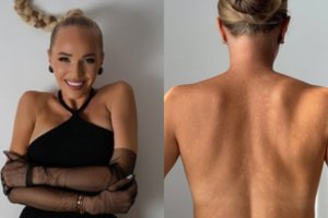 Ievą Voverį užpuolė odos grybelis: parodė, kaip tai atrodo ir kreipėsi į sekėjus