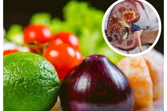 Inkstų akmenys: pasakė, kokio produkto reikėtų ypač vengti, o ką – valgyti kuo dažniau