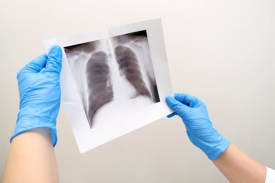 Tuberkuliozė – grėsmė gyvybei: kokie simptomai leidžia įtarti ligą