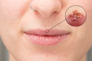 Žiema padovanojo pūslelinę? Vaistininkė atskleidė, kaip kuo greičiau ja atsikratyti