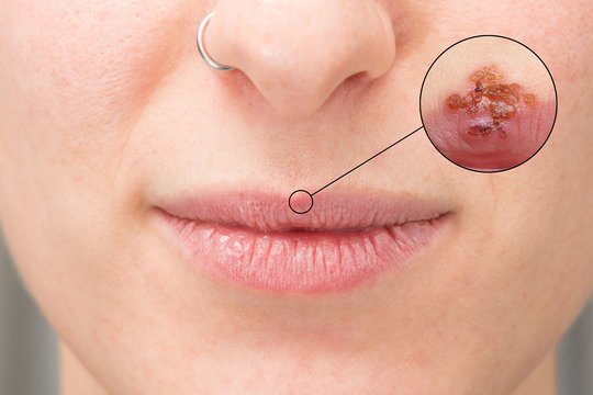 Žiema padovanojo pūslelinę? Vaistininkė atskleidė, kaip kuo greičiau ja atsikratyti