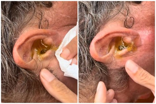 Vyrui panižo ausį – kai pamatė, kas joje buvo, išsigando visa šeima