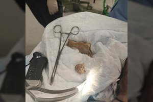 Kauno medikai pacientei iš kvėpavimo takų ištraukė kepsnį: pasidalino nuotrauka