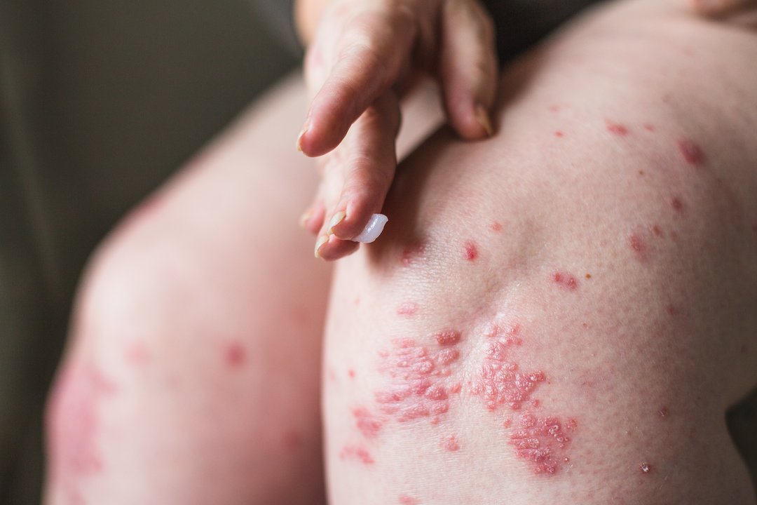 10 klausimų apie psoriazę: kodėl žiemą paūmėja žvynelinė?