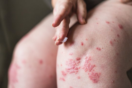 10 klausimų apie psoriazę: kodėl žiemą paūmėja žvynelinė?