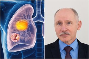 Profesorius: ypač mirtinas vėžys skausmo nesukelia, bet išsiduoda kitu būdu