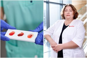 Gydytoja įspėja dėl dažnai pamirštamo kraujo rodiklio: perteklius sukelia demenciją
