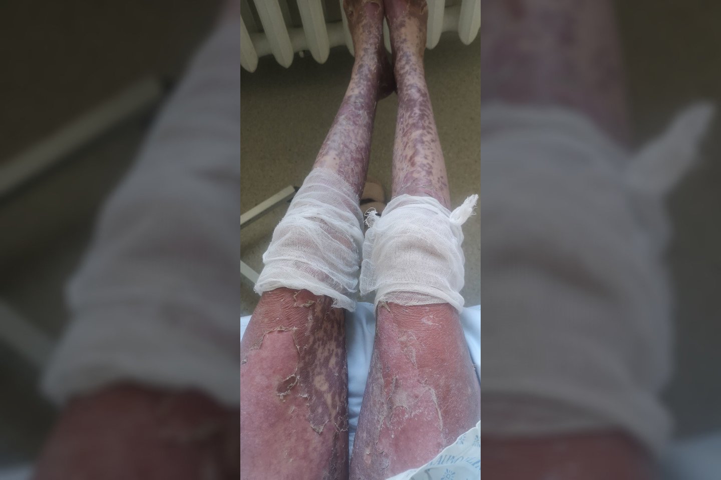 „Su kiekviena diena jaučiausi ir atrodžiau vis blogiau“, – pasakoja toksin epidermine nekrolize susirgusi Karolina.<br>Asmeninio albumo nuotr.