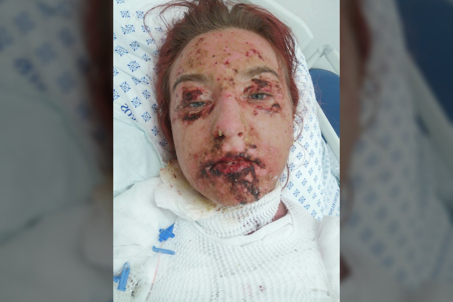 „Su kiekviena diena jaučiausi ir atrodžiau vis blogiau“, – pasakoja toksin epidermine nekrolize susirgusi Karolina.<br>Asmeninio albumo nuotr.