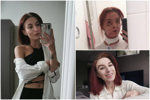 Kaunietės košmaras – kūną nusėjo žaizdos ir luposi oda: klykiau iš skausmo, slaugės verkė kartu